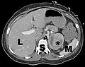 Phaeochromozytoma CT labelled.jpg