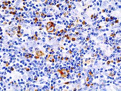 Hodgkin lymphoma (4) CD30 immunostain.jpg