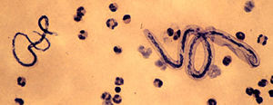 Mikrofilarie von Loa loa (rechts) und Mansonella perstans (links) im selben Blutausstrich
