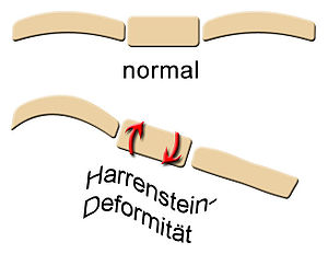 Harrenstein-Deformität.jpg