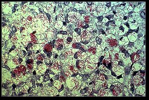 Mycobacterium leprae in Ziehl-Neelsen-Färbung