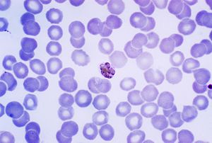 Reifer Schizont von Plasmodium malariae im gefärbten Blutausstrich
