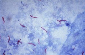 Mycobacterium tuberculosis (Ziehl-Neelsen-Färbung)