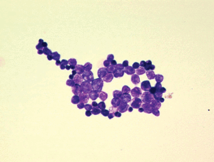 Prototheca wickerhamii (Gram-Färbung) aus dem Blut eines 79-jährigen Mannes mit Sepsis