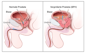 Schaubild, das normale und vergrößerte Prostata im Vergleich zeigt