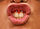 Lip frenulum piercing closeup.jpg
