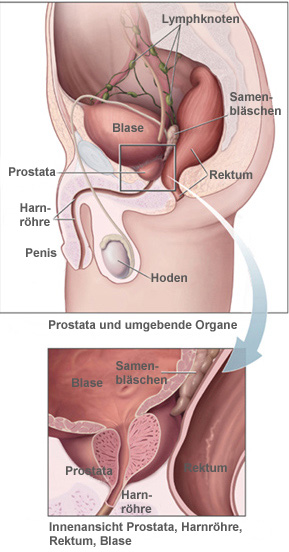prostatitis lymphknoten